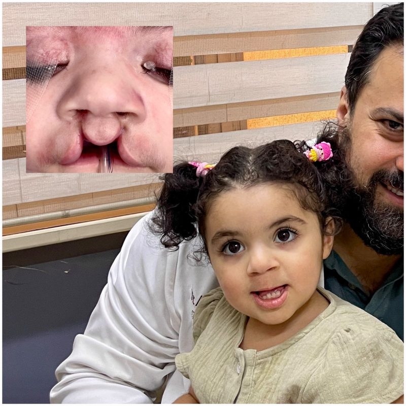 شق الشفة والحنك
