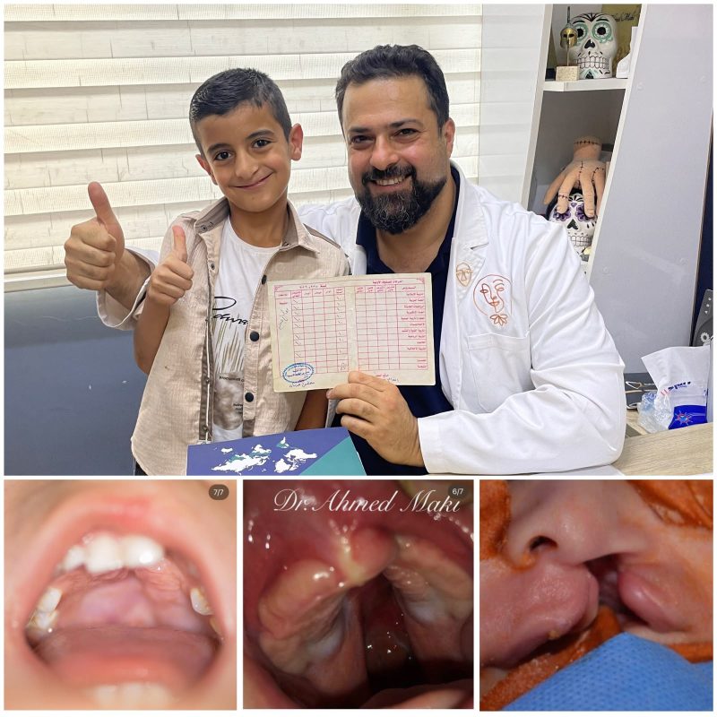 متابعة بعد عملية ترميم شق الشفة